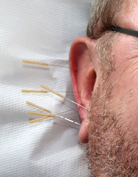 akupunktur200